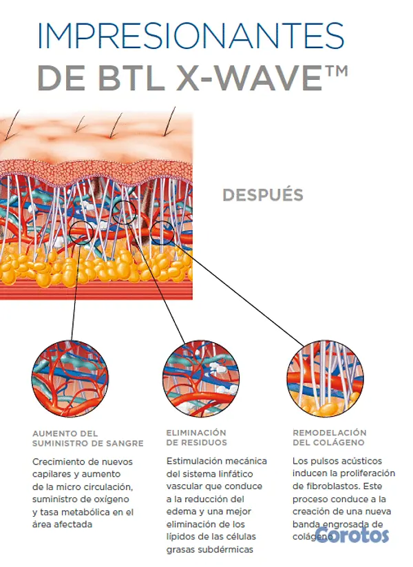 Salud y Equipamiento Médico - VENDO ONDAS DE CHOQUE COMO NUEVO 2