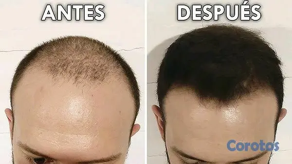 salud y belleza - Minoxidil de la maraca kirkland 3